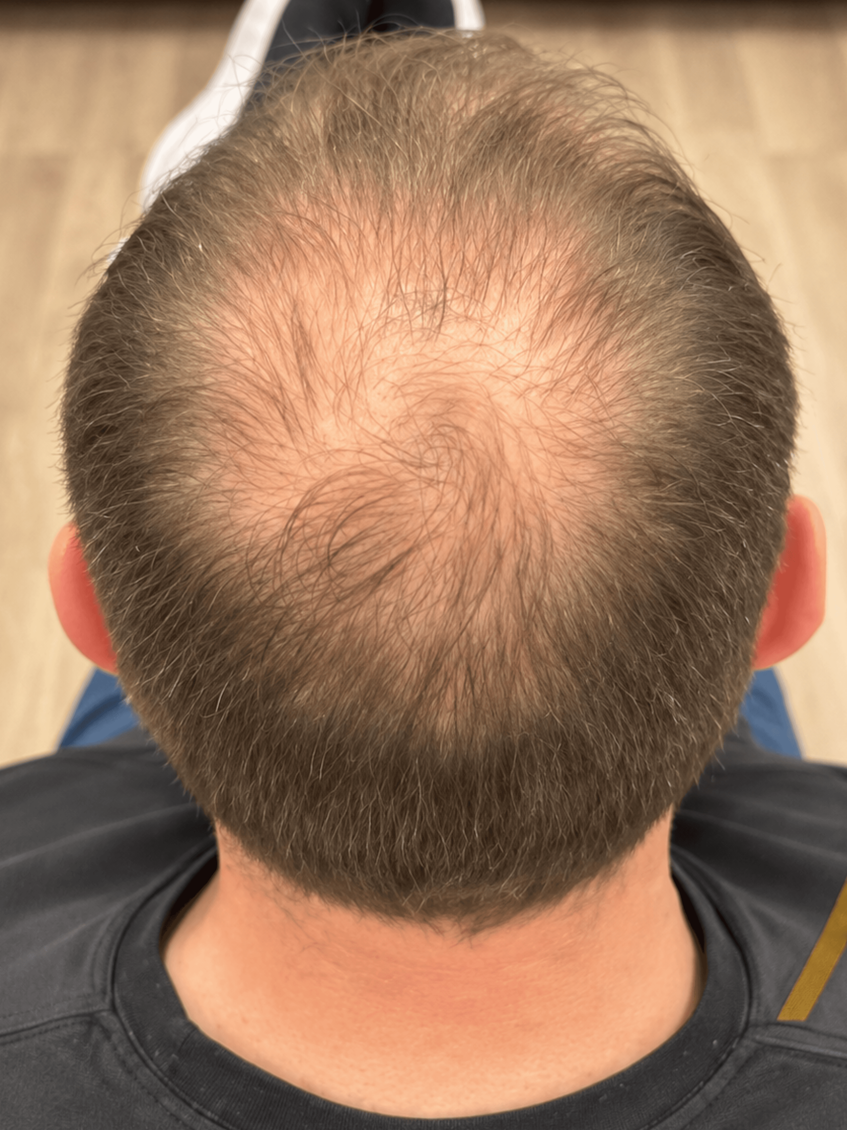 Supplied before photograph of the scalp for the 5-month comparison
